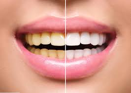 Saakshatv healthtips shiny teeth