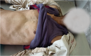 sakleshpur-Man dies in Elephant saaksha tv