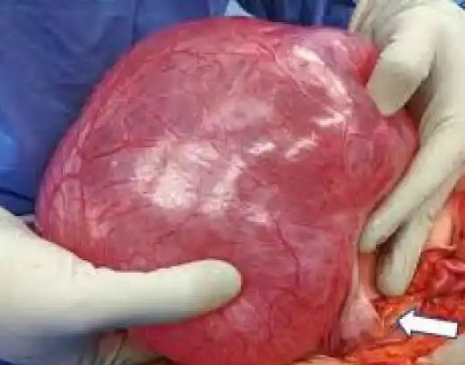 volleyball sized tumor