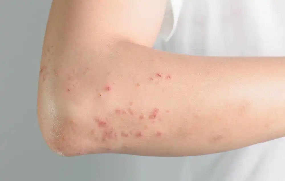 try some home remedies for skin allergy due to makeup