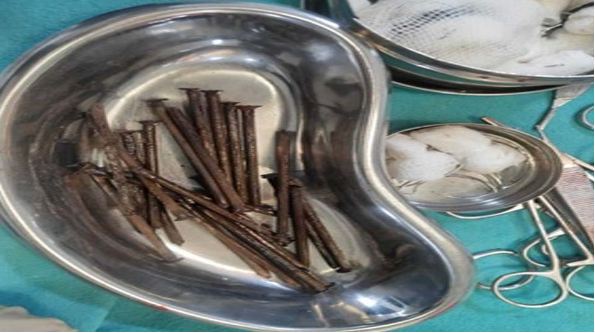 ತಂದೆ ಬೈದರೆಂದು 21 ಕಬ್ಬಿಣದ ಮೊಳೆಗಳನ್ನ ನುಂಗಿದ  ಅಪ್ರಾಪ್ತ..!