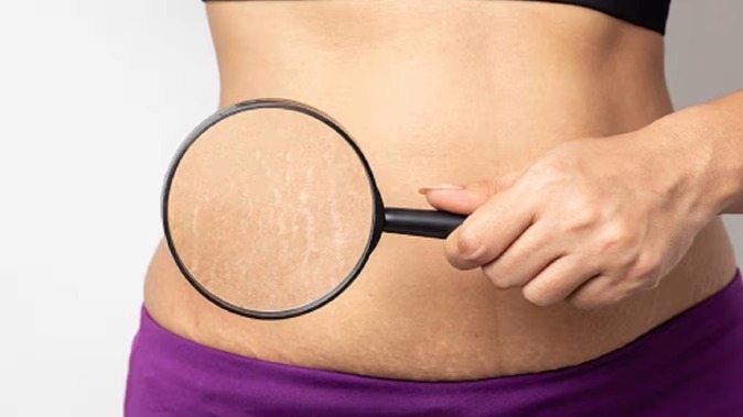 Remove Stretch Marks – ಪ್ರೆಗ್ನೆನ್ಸಿ ನಂತರದ ಸ್ಟ್ರೆಚ್ ಮಾರ್ಕ್ಸ್ ತೊಲಗಿಸಲು ಈ ವಿಧಾನಗಳನ್ನ ಟ್ರೈ ಮಾಡಿ..