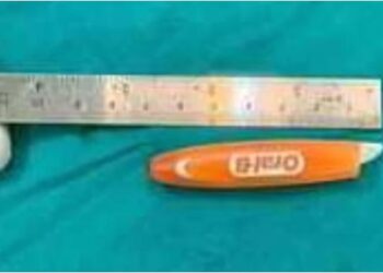 KIMS DOCTORS REMOVED BROKEN TOOTHBRUSH FROM WOMAN EYE saaksha tv