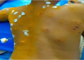 Bantwala boy-dies-after-stung-by-bees