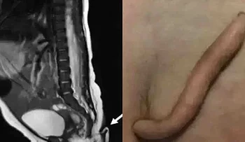 Mexico ಬಾಲದೊಂದಿಗೆ ಜನಿಸಿದ ವಿಶಿಷ್ಟ ಹೆಣ್ಣು ಮಗು