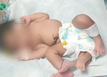 Baby Girl In Madhya Pradesh Born With 'Four' Legs