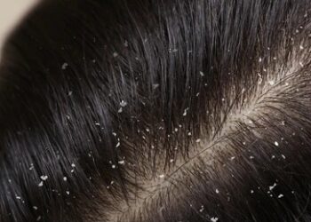 dandruff