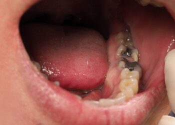 Tooth Decay