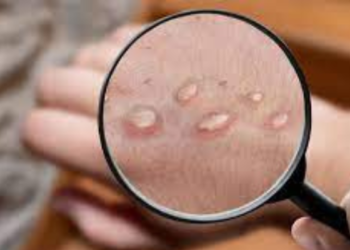 ಮಂಕಿಪಾಕ್ಸ್ ಇನ್ನು ಜಾಗತಿಕ ಆರೋಗ್ಯ ತುರ್ತು ಸ್ಥಿತಿಯಲ್ಲ!