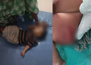 ಕೋತಿಗಳ ದಾಳಿಯಿಂದ ಗಂಭೀರವಾಗಿ ಗಾಯಗೊಂಡಿರುವ ಮಗು
