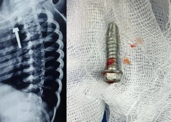 ಆಟವಾಡುತ್ತ ಬೋಲ್ಟ್ ನುಂಗಿದ ಬಾಲಕ! ಮುಂದೇನಾಯ್ತು?