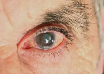 ಗ್ಲೂಕೋಮಾ ( Glaucoma ) – ಇರಲಿ ಎಚ್ಚರಿಕೆ
